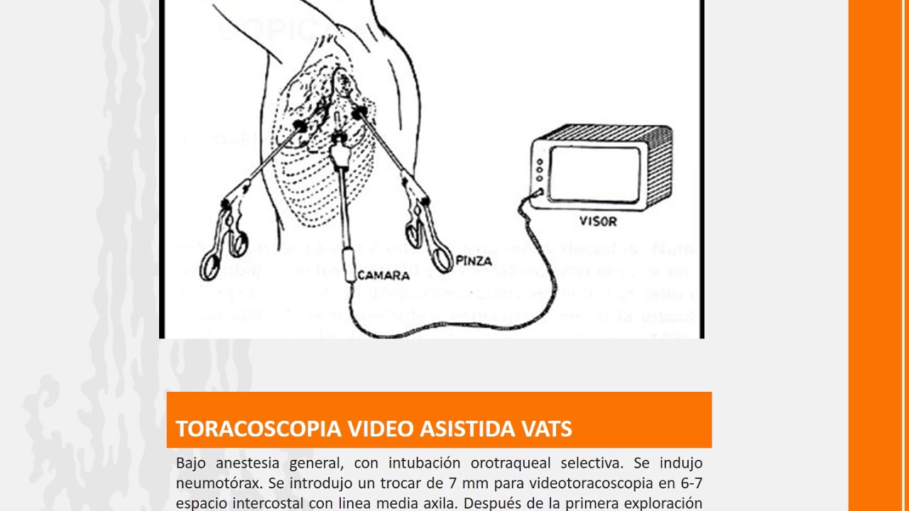 Instrumentaci&oacute;n e Innovaci&oacute;n: Radioguided VATS