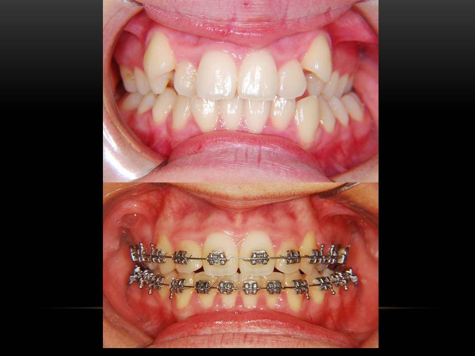 High Canine Teeth! Orthodontist