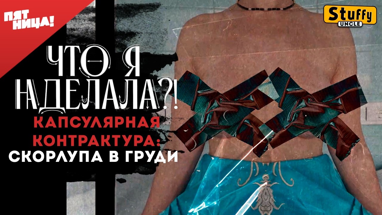 Что я наделала? - Капсулярная контрактура: скорлупа в груди