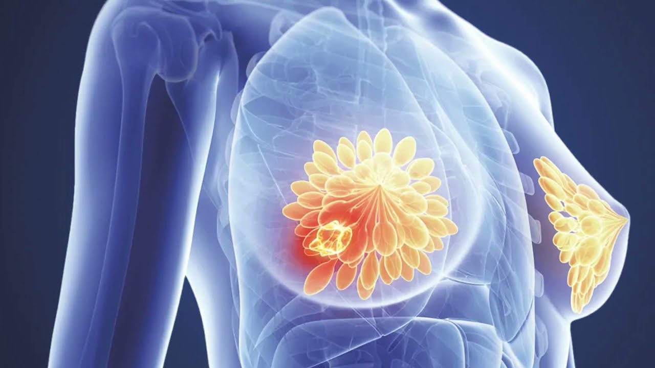Predicting breast cancer – How IARC scientists read the map hidden in an individual’s blood