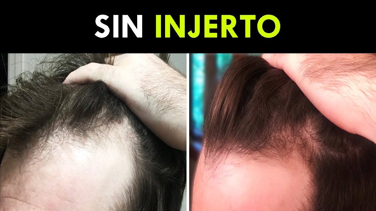 Su Pelo Vuelve De La Tumba En 4 Meses
