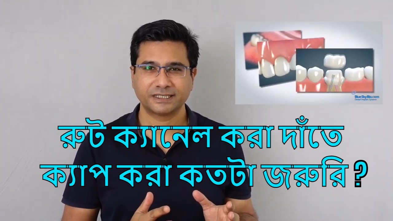 রুট ক্যানেল করা দাঁতে ক্যাপ করা কি জরুরি ?