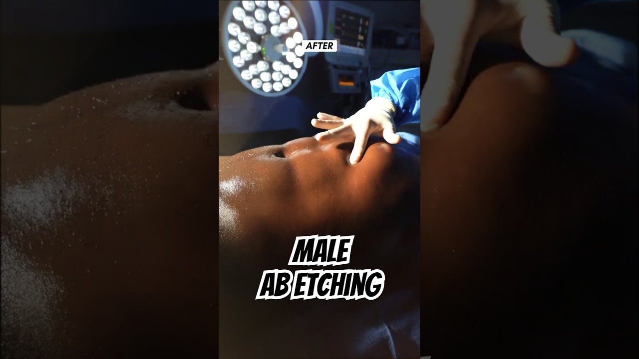 Transforming the Male Form: Before & After Ab Etching with Dr. Luster! 💪✨