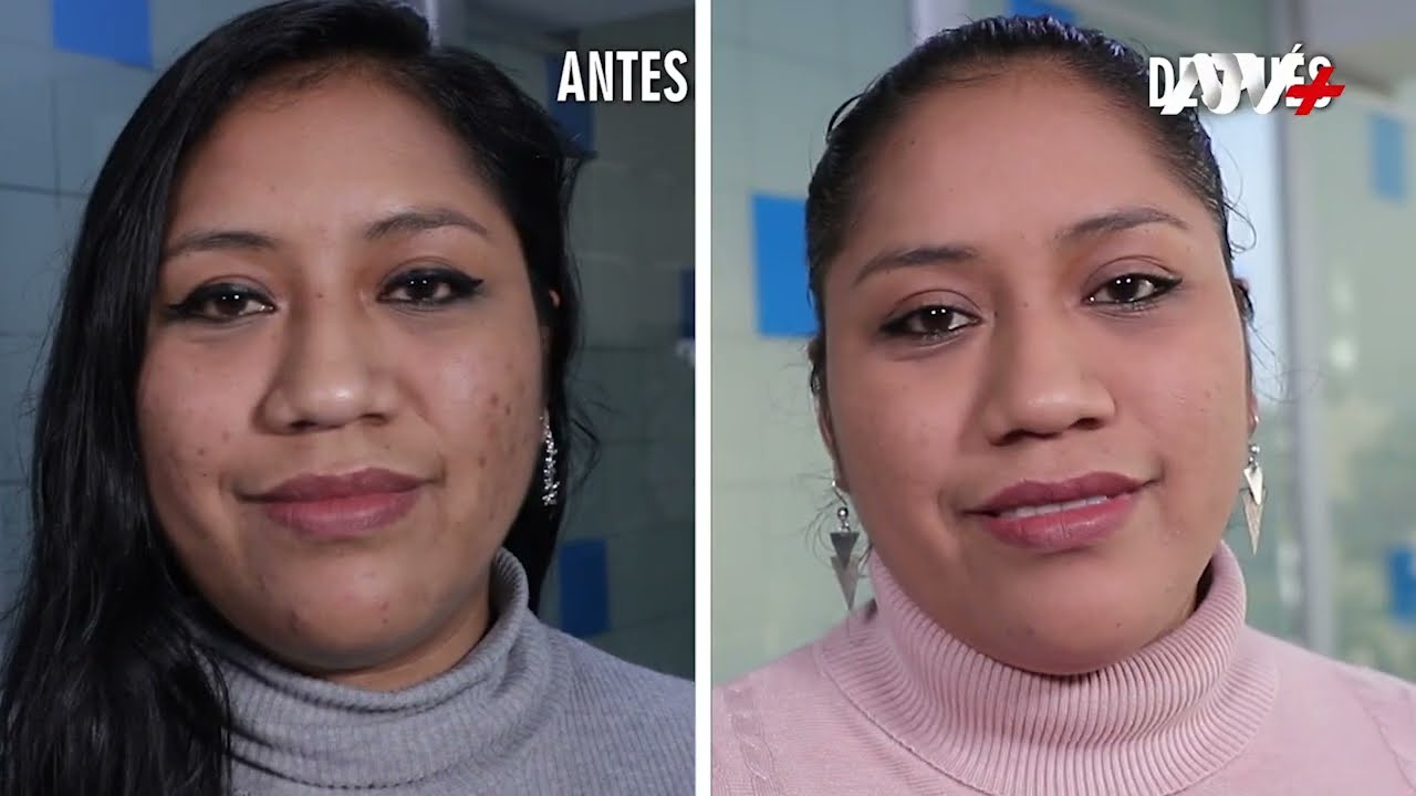 ✨ELIMINA LAS SECUELAS DEL ACNÉ CON EL LÁSER CO2 FRACCIONADO - DR. FELIX VÁSQUEZ LAPEL👨🏻‍⚕️