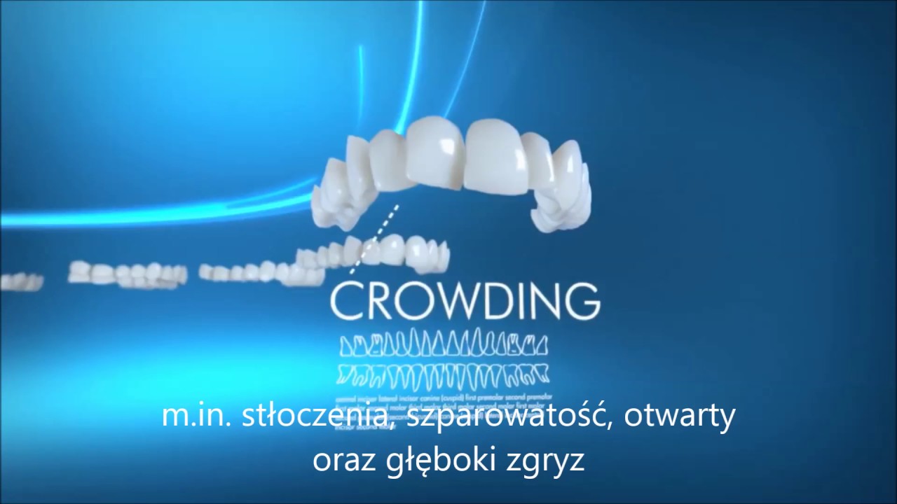 INVISALIGN niezależnie od wady zgryzu