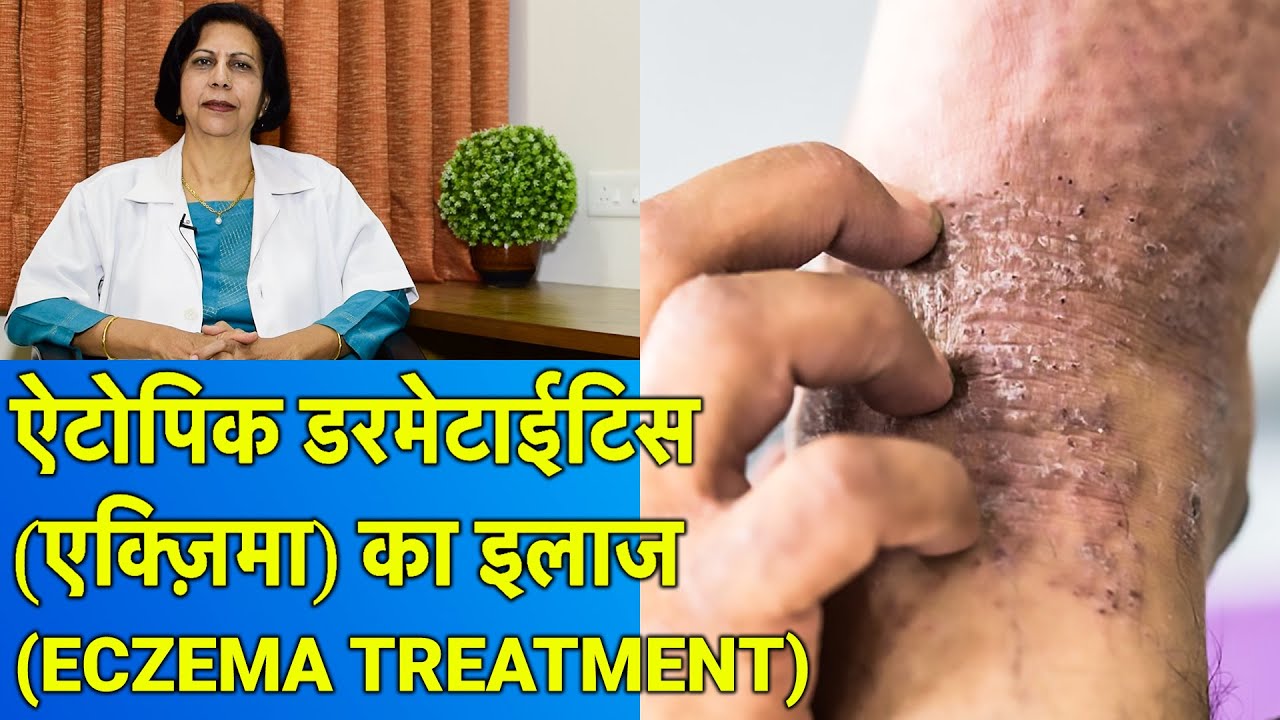 एक्ज़िमा / एलर्जी दाद खाज खुजली का ईलाज || Eczema Treatment