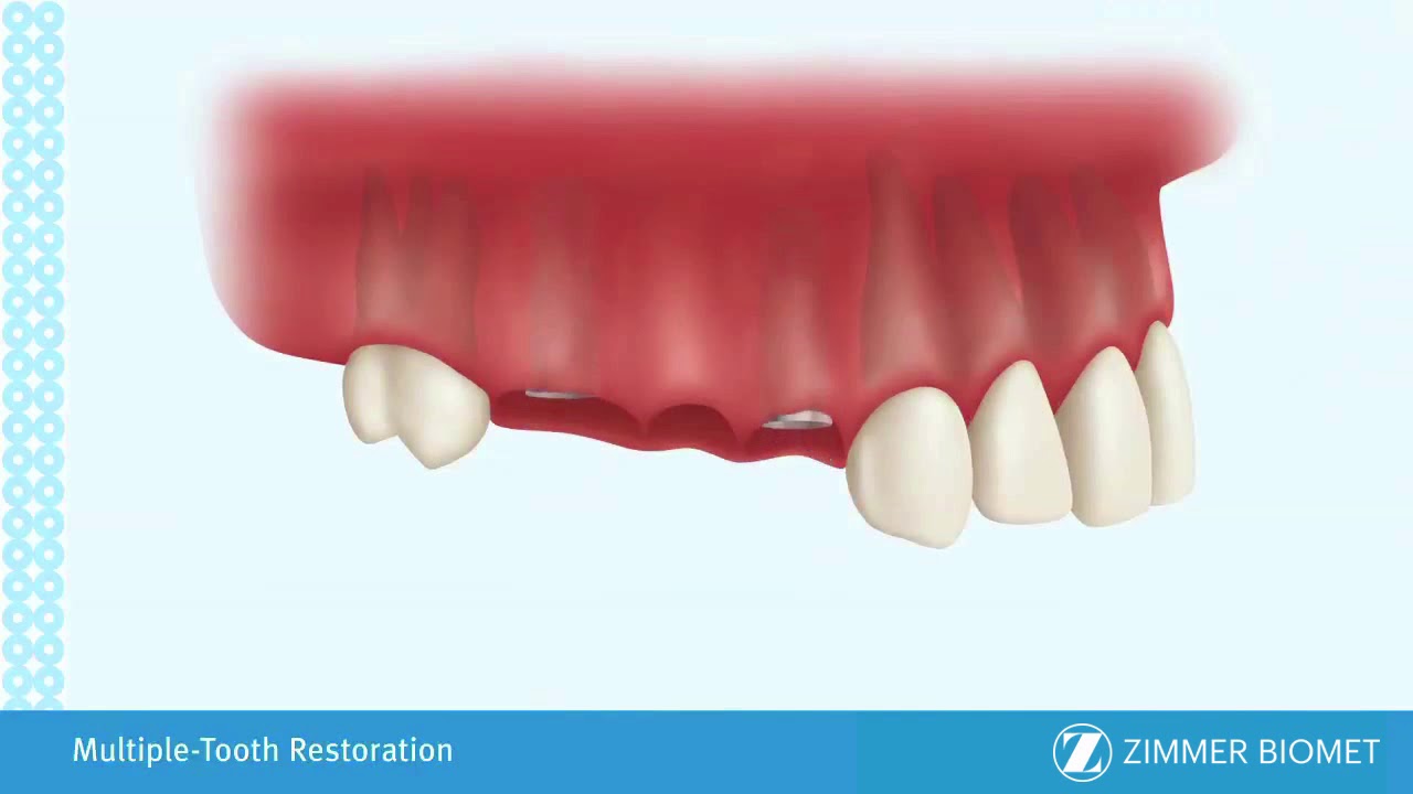 Multiple Tooth Restoration | Dental Implants Washington DC
