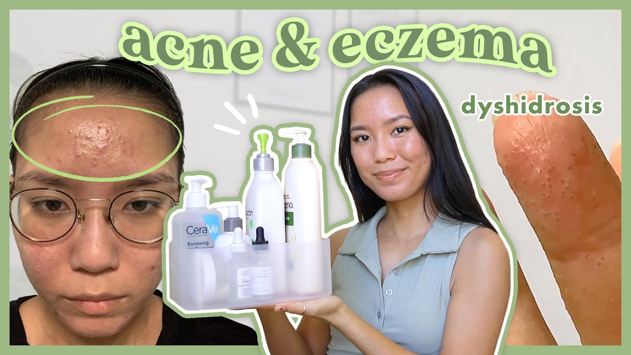 How I Treat My Acne & Eczema 🧴 Skincare Faves + Tips (redness, texture, dyshidrosis)