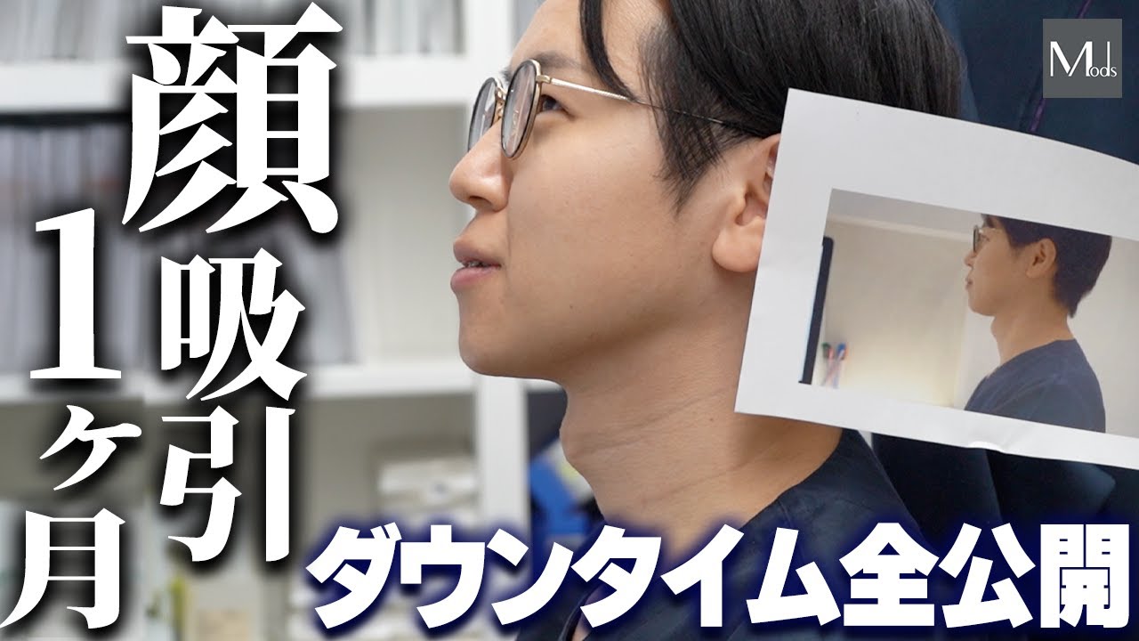 1ヶ月のダウンタイム記録！脂肪吸引ドクターが受けた顔の脂肪吸引のその変化とは！【モッズクリニック】