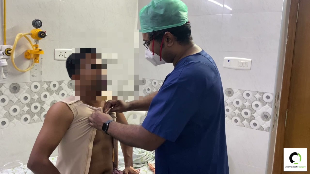 Gynecomastia Surgery Results - Chennai Plastic Surgery