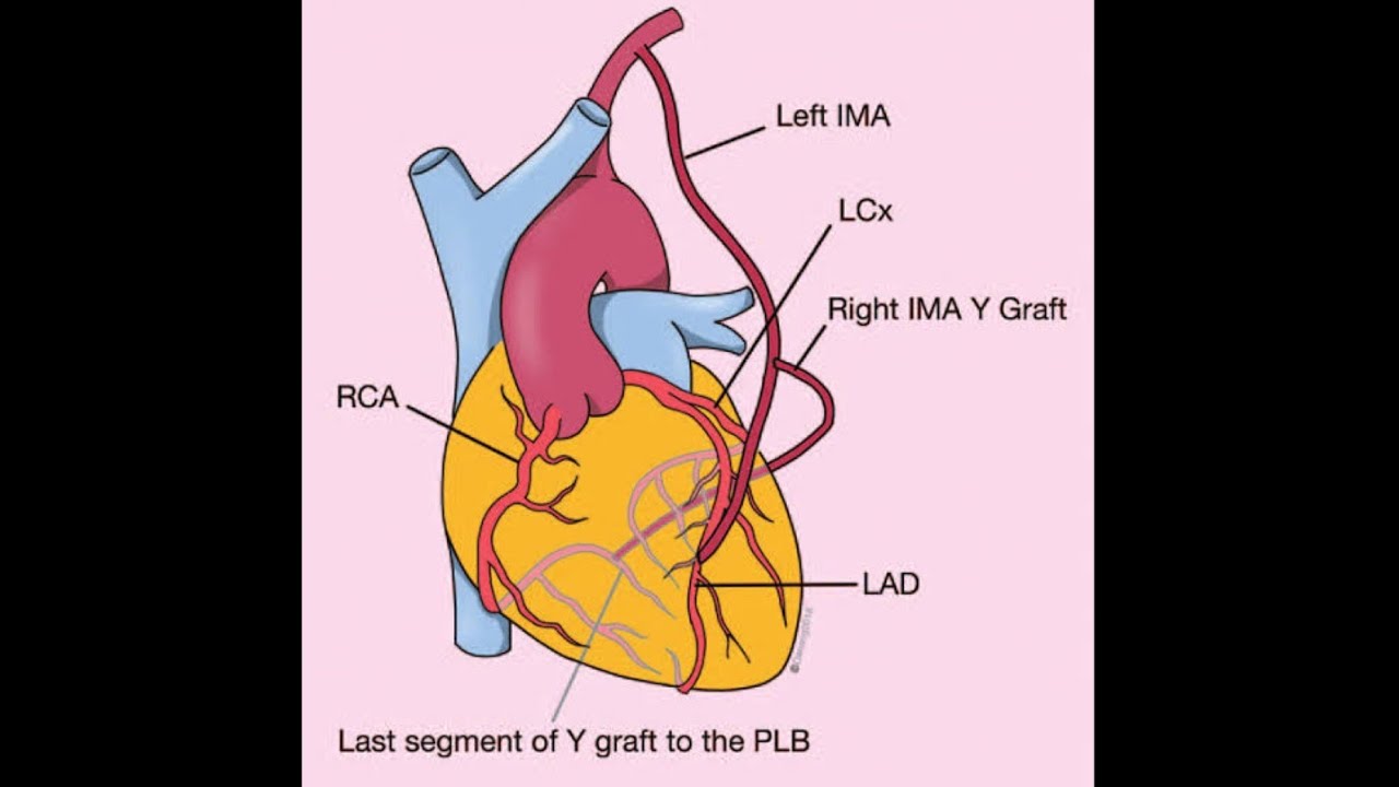 LIMA-RIMA-Radial artery Y graft.   Beauty of LIMA-RIMA YGraft.#angiogram