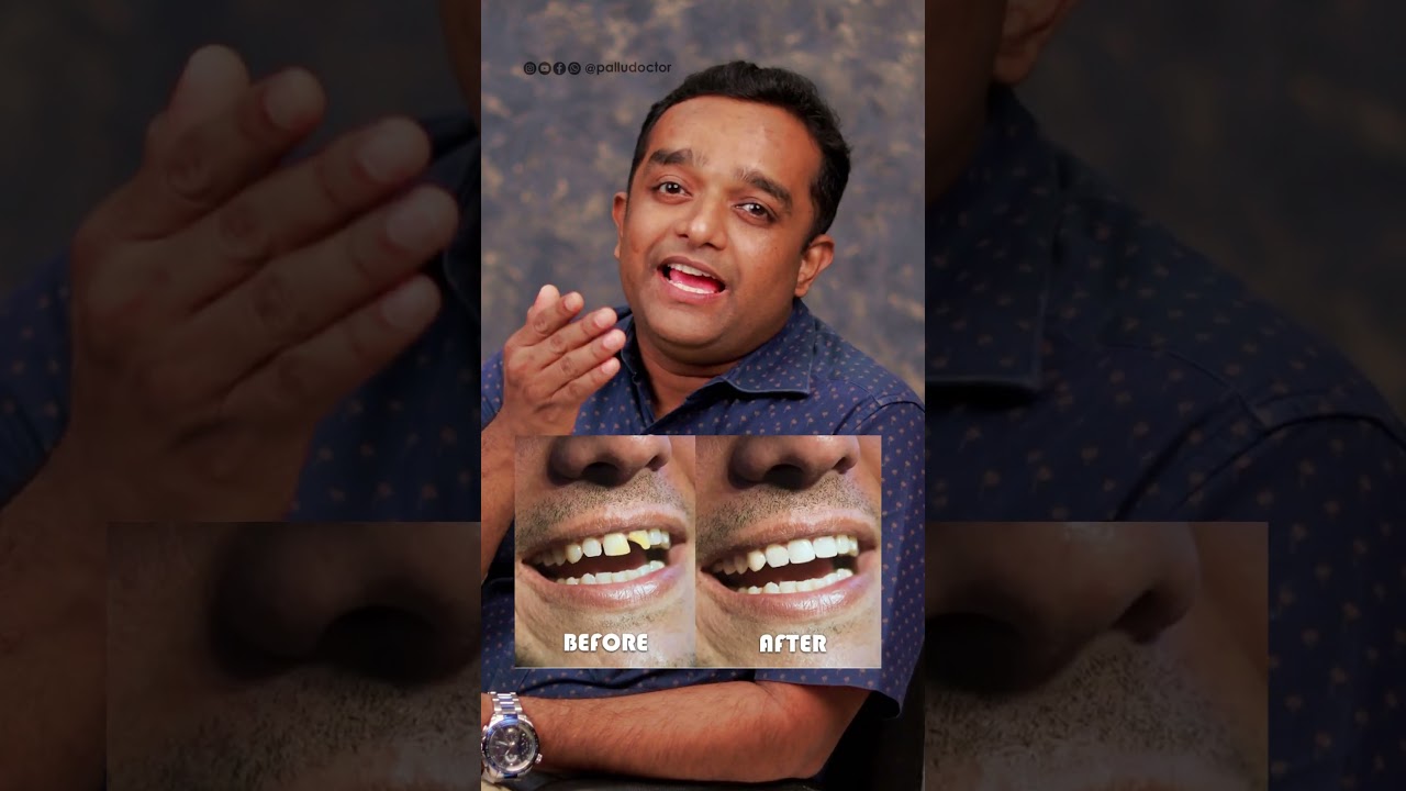 അര മണിക്കൂറിൽ പല്ല് ശെരിയാക്കാം #dentalclinic #dentaltips #dentalcrowns #dentalveneers #smile