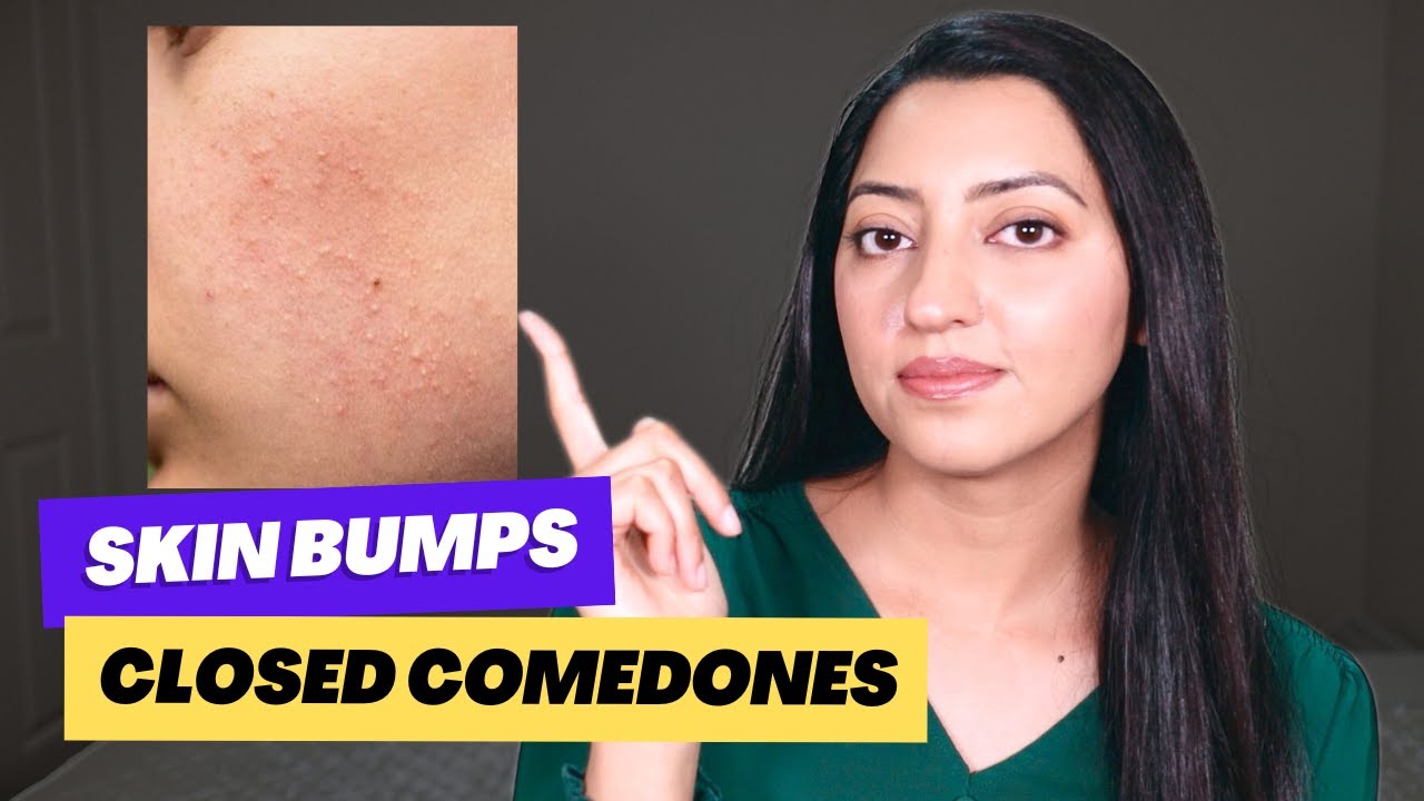 How to Get Smooth Skin | Skin texture and Bumps | Science Based Solution