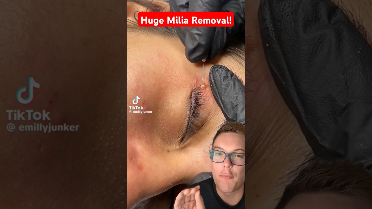 WORLDS BIGGEST MILIA REMOVAL - Huge Milia Under Eye #shorts