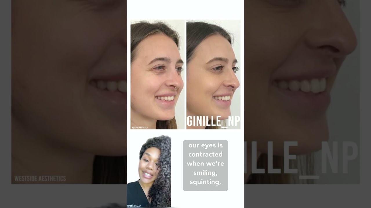 Botox for crows feet, before and after #botox #crowsfeet #smilelines #botoxinjections #botoxfacial