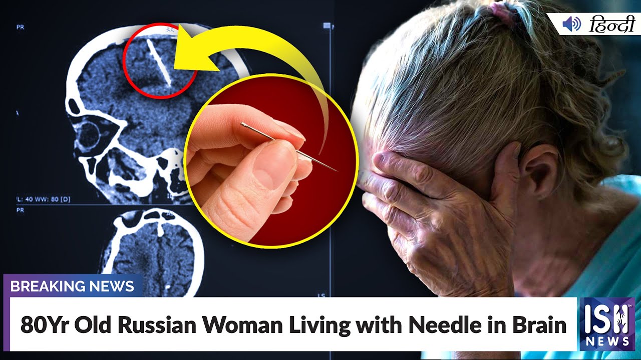 80Yr Old Russian Woman Living with Needle in Brain | ISH News