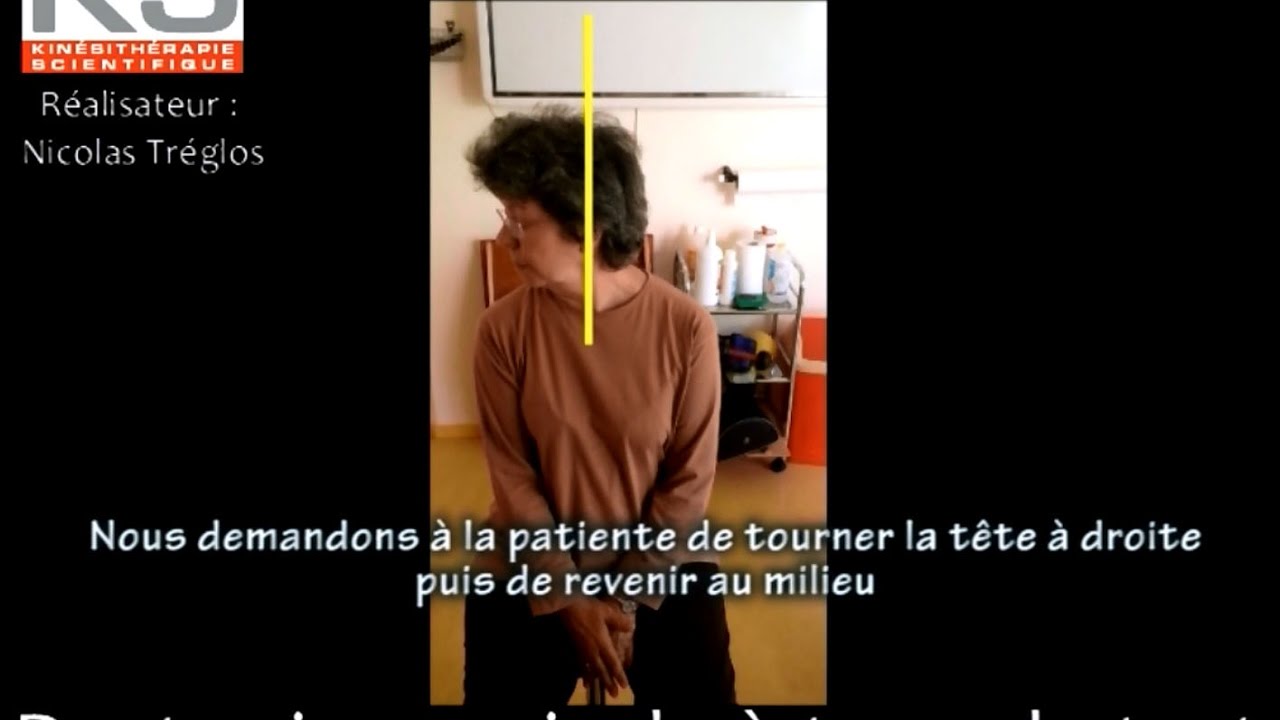 Dystonie cervicale à type de torticolis droit