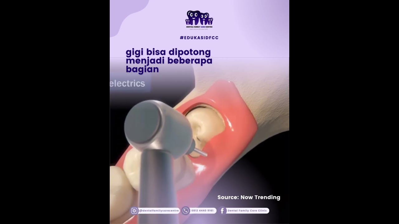 Proses Perawatan Pencabutan Gigi Impaksi!