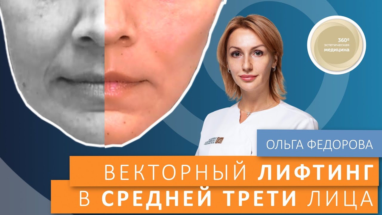 Векторний ліфтинг у середній третині обличчя з препаратом Radiesse