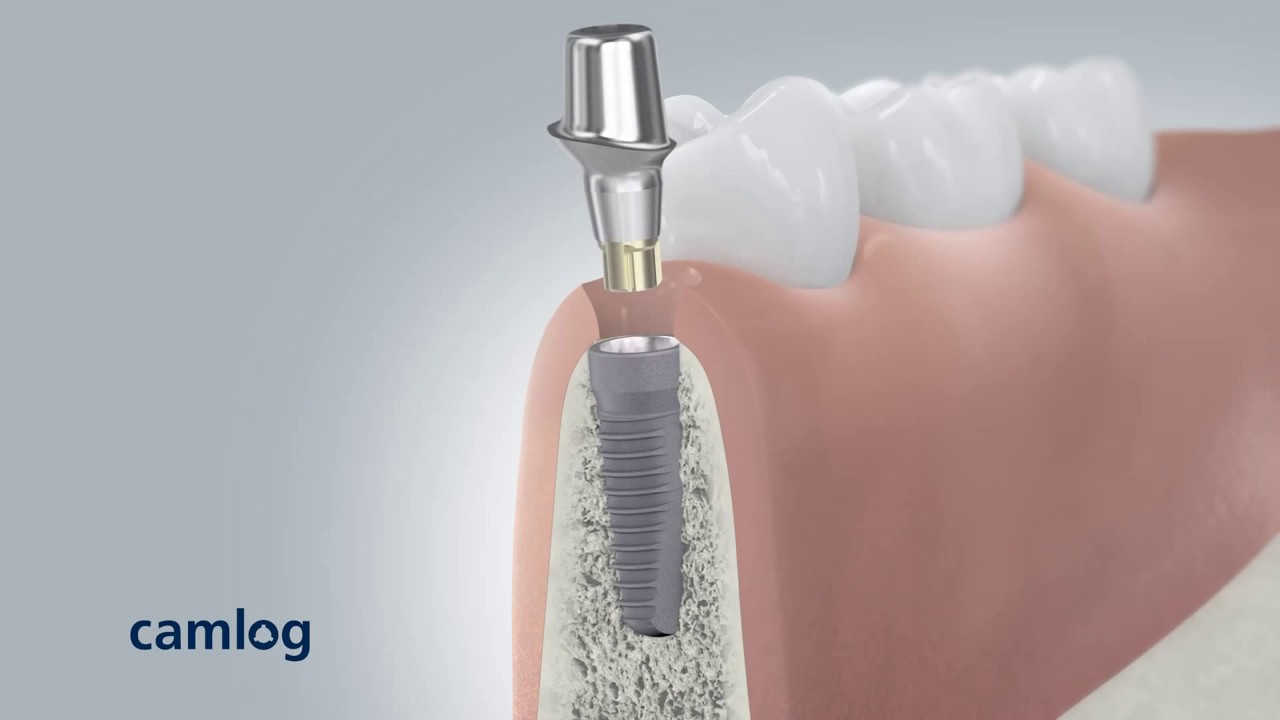 Dental animation Camlog Implant System 3D Animation Medizin