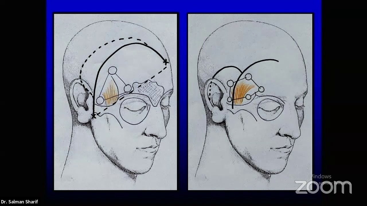10 Bases of Craniotomies