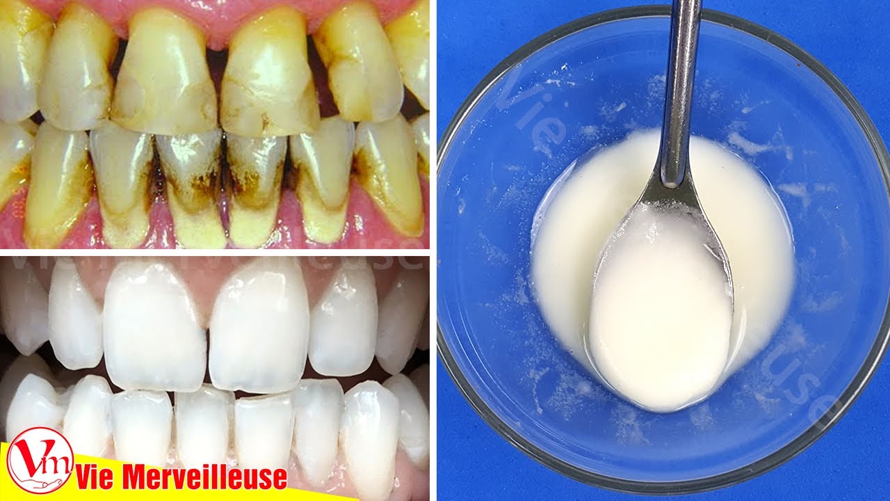 Comment Enlever Tartre En 2 Minutes | Utiliser Ce M&eacute;lange Pour Obtenir Des Dents Blanches Naturelles