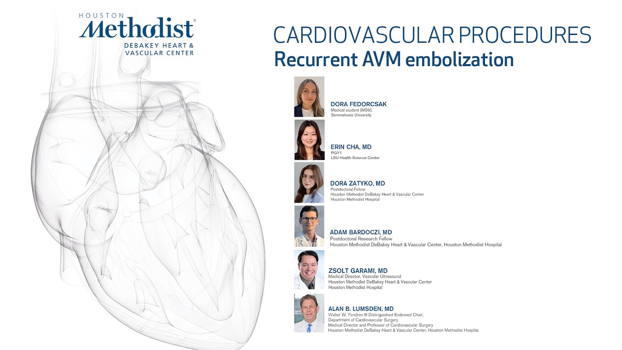 Recurrent AVM Embolization