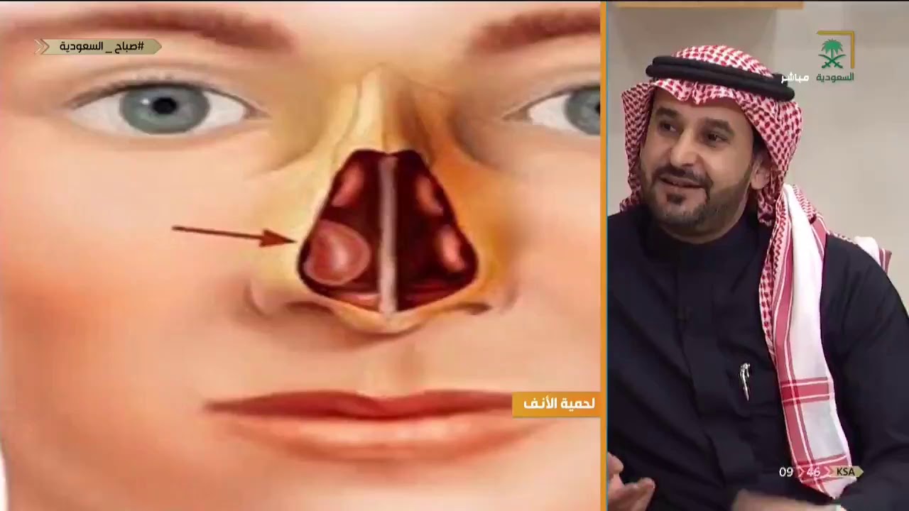#صباح_السعودية | ماهي لحمية الأنف وأنواعها ؟ مع د. يزيد الغنيم - استشاري جراحة الوجه التجميلة