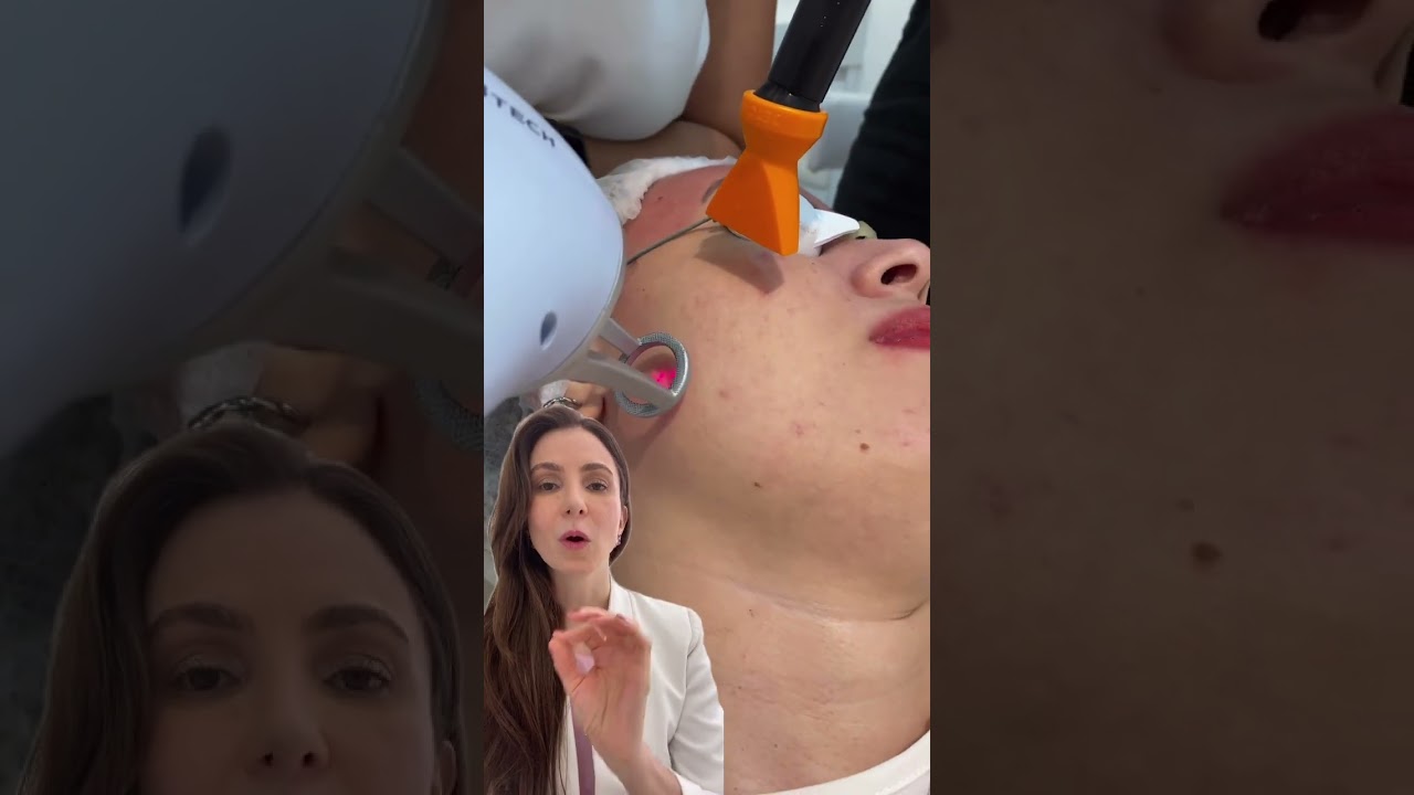 Laser Lavieen - como fica a pele após a aplicação
