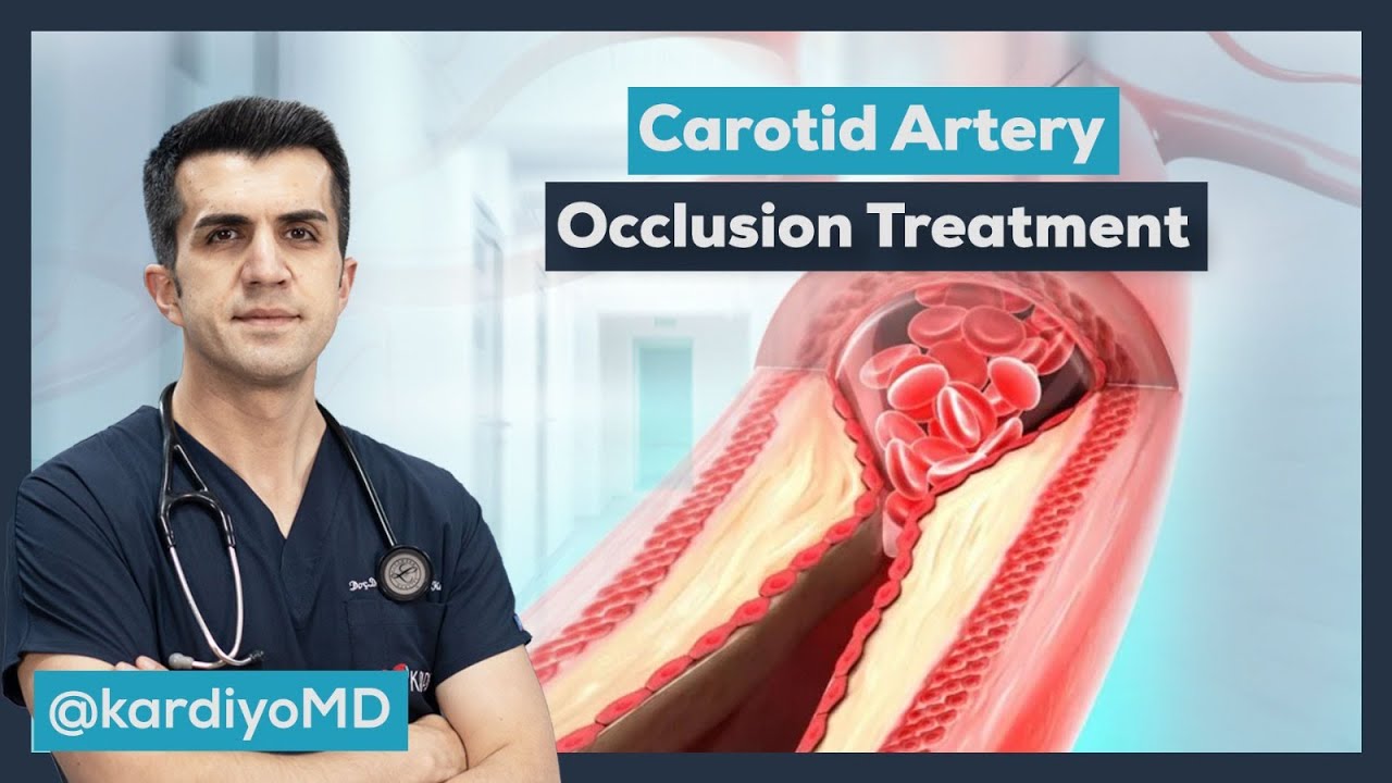 How to Open a Carotid Artery Blockage?