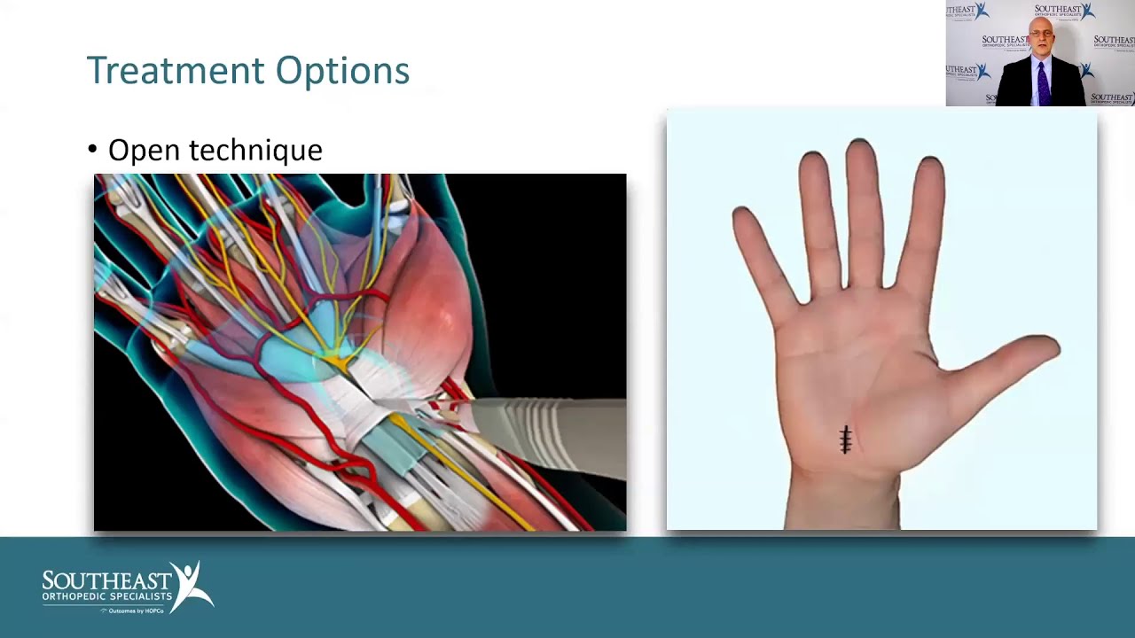 Understanding Carpal Tunnel Syndrome with Dr. Brett Puckett | Southeast Orthopedic Specialists