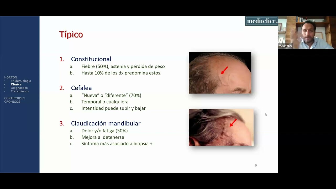 Aretritis de Horton (una enfermedad rara) y uso crónico de CORTICOIDES