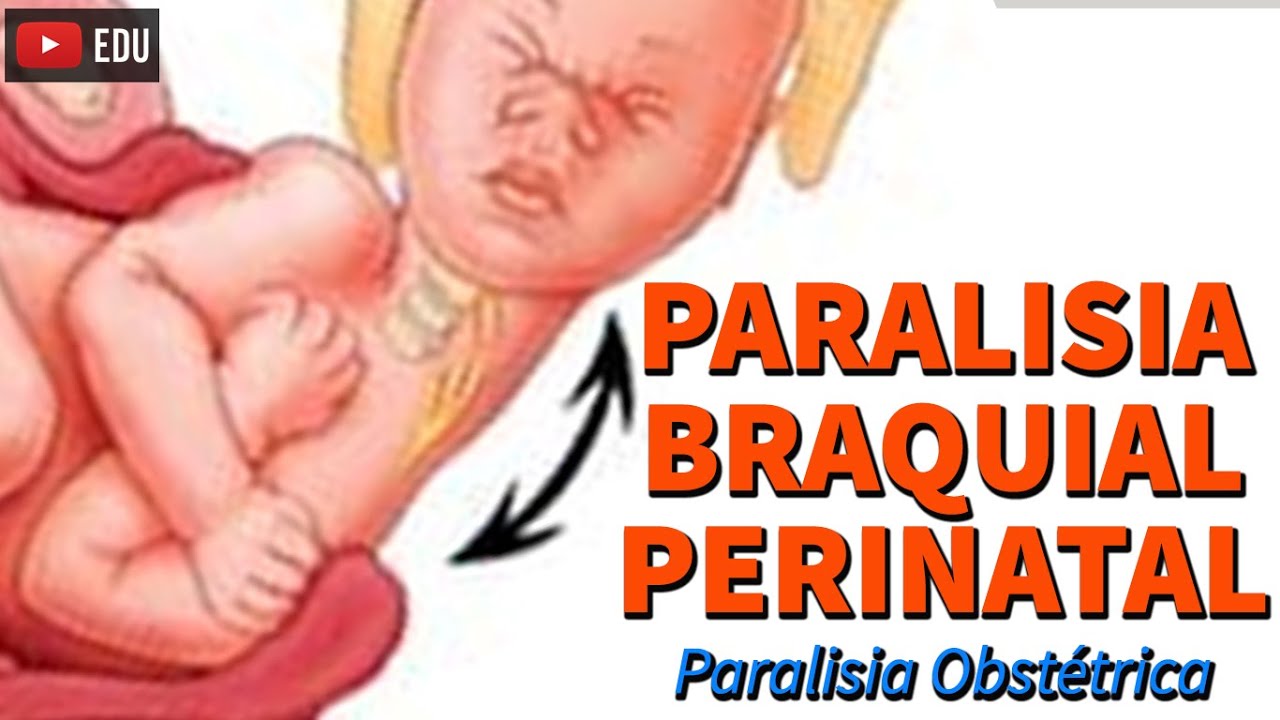 PARALISIA BRAQUIAL PERINATAL (PARALISIA OBSTÉTRICA) - Rogério Souza