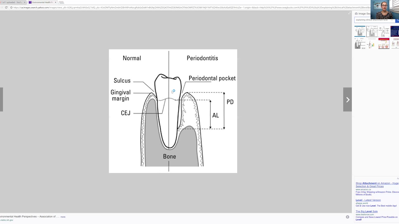 Clinical Attachment Level Explained the Easy Way
