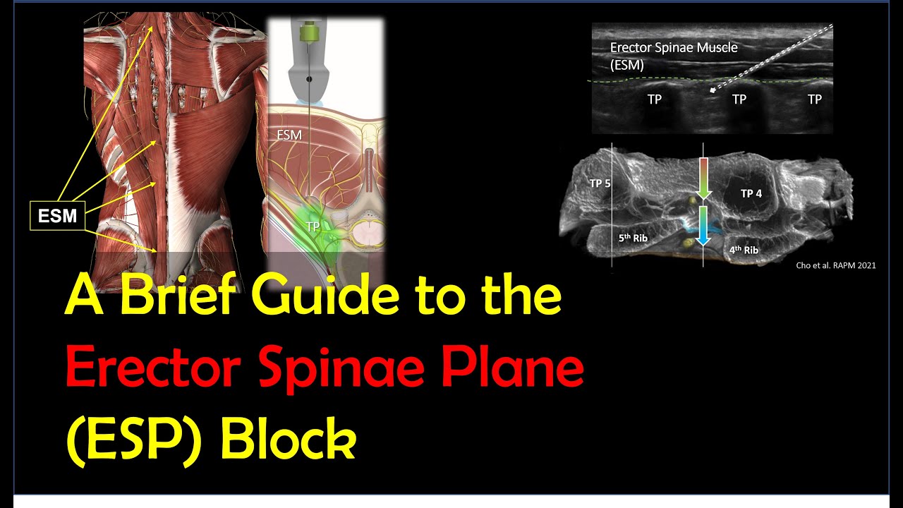 ESP Block - How To Perform It Effectively & Safely (2022)