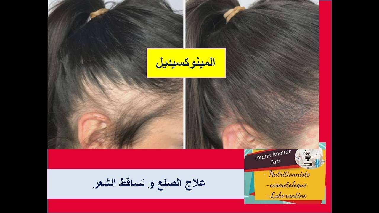 أقوى علاج لإنبات الشعر وتساقط الشعر FDA approved  المينوكسيديل/ جميع المعلومات قبل بدء العلاج
