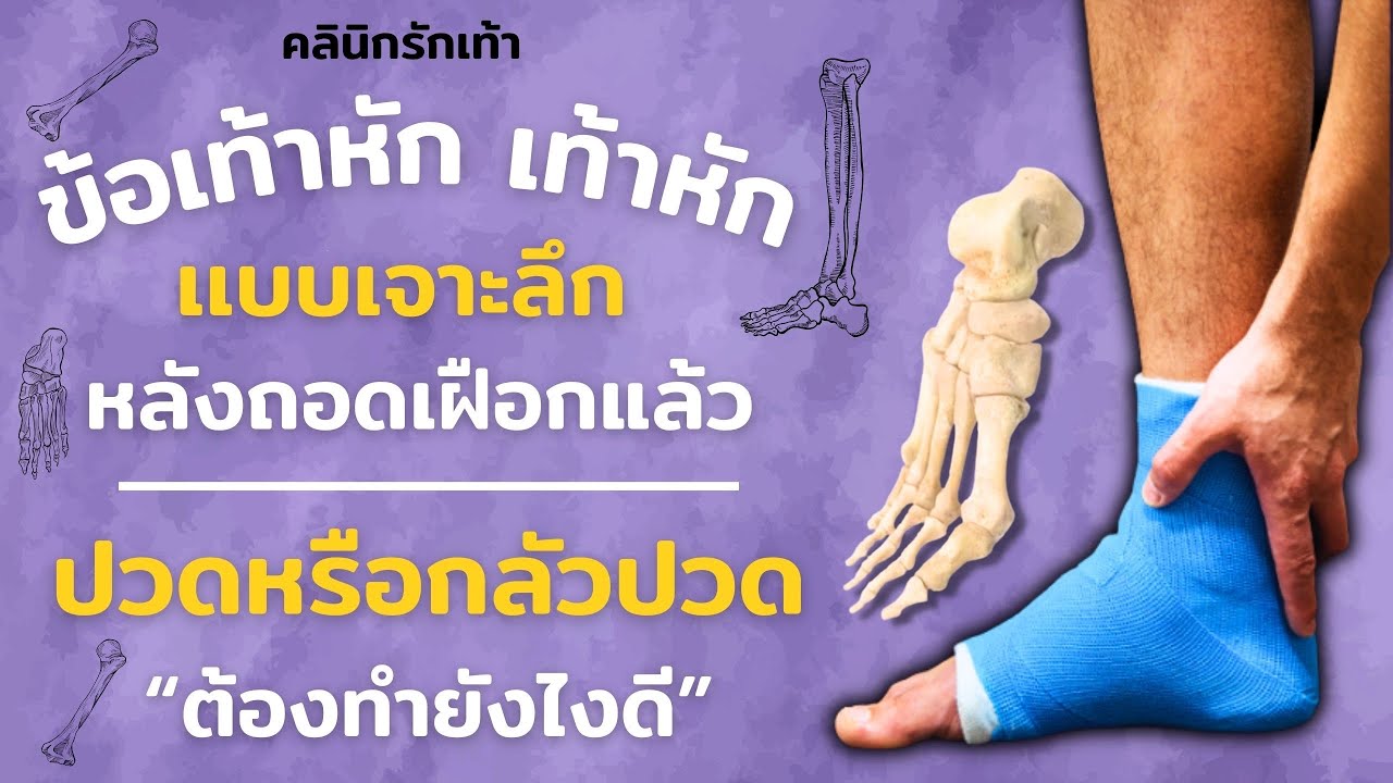 เท้าหัก ข้อเท้าหัก นิ้วเท้าหัก หลังถอดเฝือก แล้วมีอาการปวด หรือกลัวปวด จะต้องทำยังไงดี
