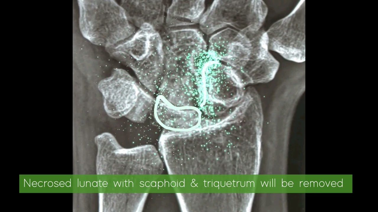 Kienbocks disease - #kienbocks #proximalrowcarpectomy #wristpain