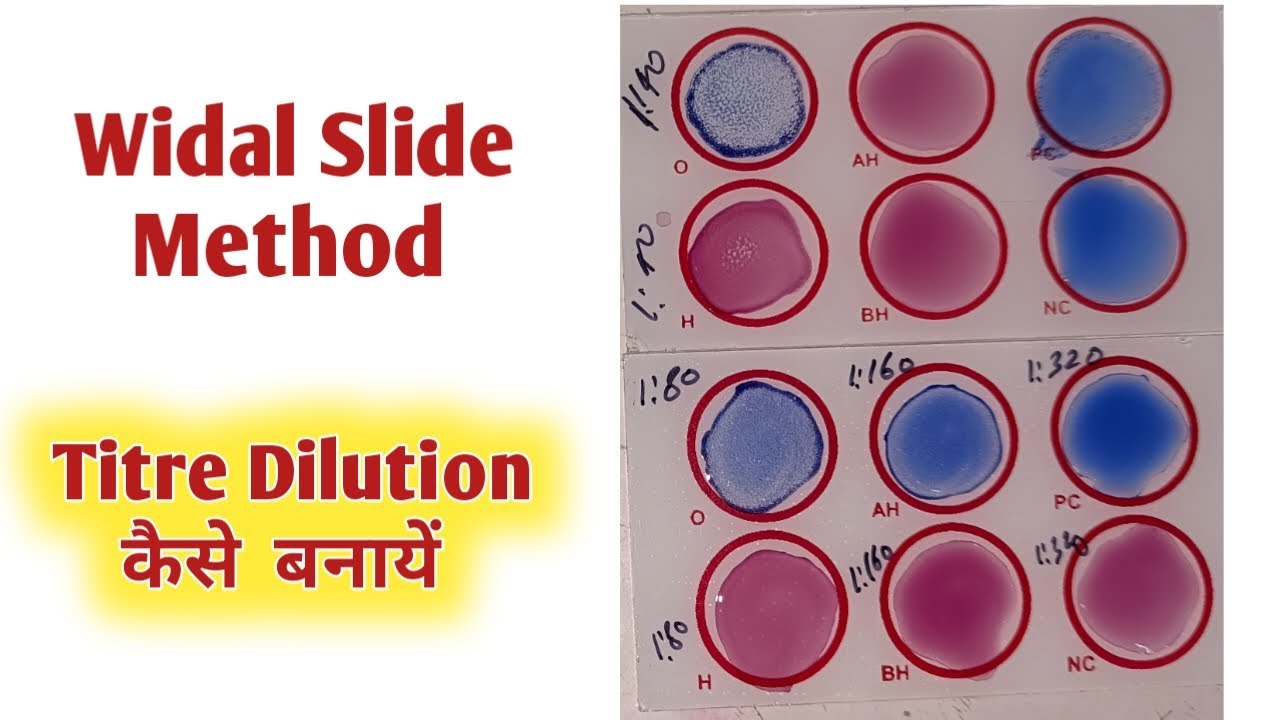 widal test titre procedure I widal test dilution method