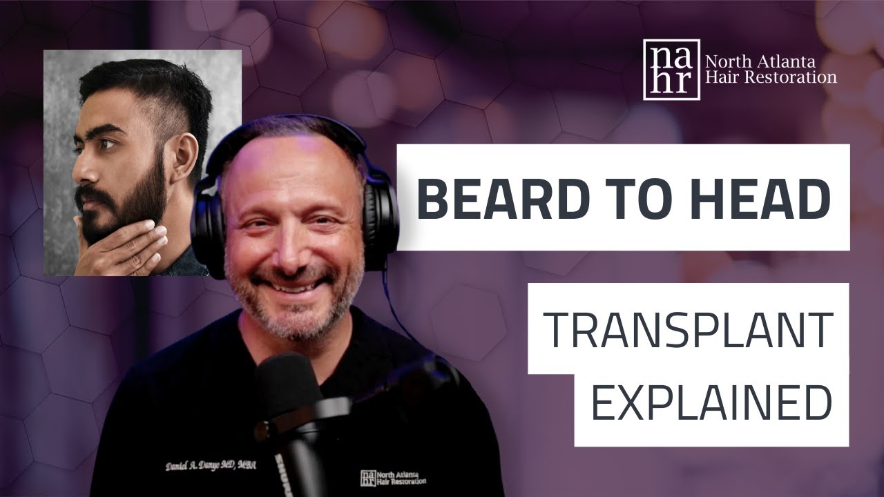 Beard To Head Hair Transplant Explained