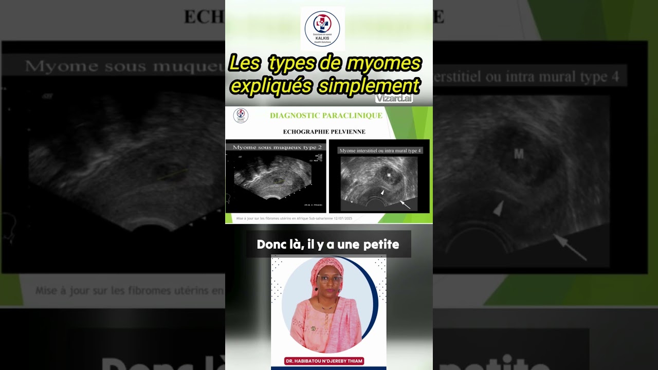Les  types de myomes expliqu&eacute;s simplement