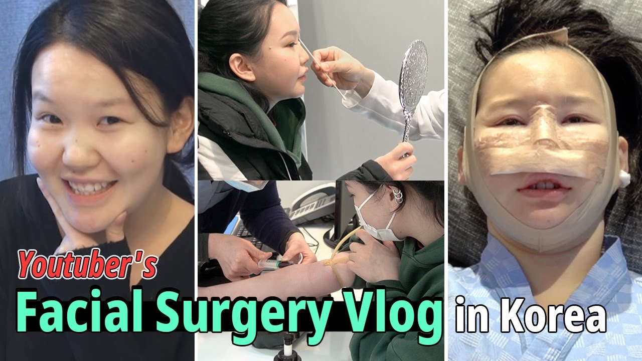 [SUB] Youtuber's Plastic Surgery Vlog in Korea | Rhinoplasty, Facial Liposuction with Lifting