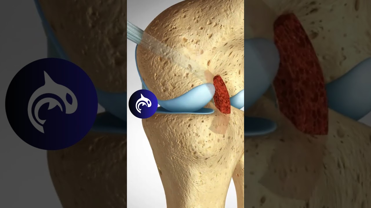 How Surgeons Fix PCL Tears: Patellar vs. Hamstring Graft Techniques - 4K 3D Animation
