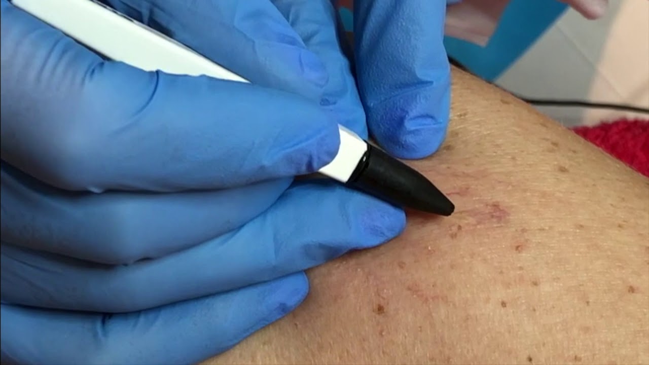 Removal of Red Thread Veins | Appearances Aesthetics