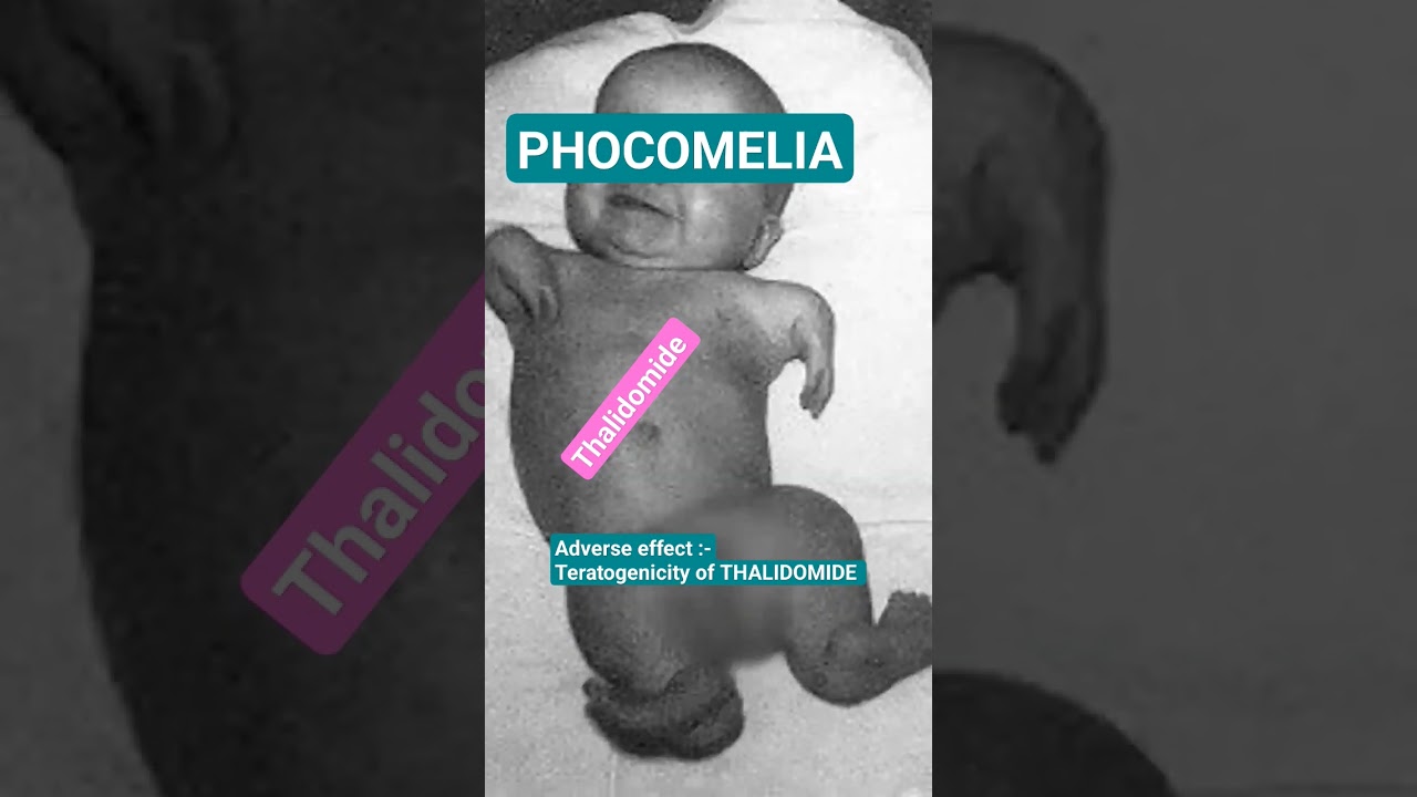 phocomelia -teratogenicity of thalidomide #adverse #effects #thalidomide#dermatology#skincare#neetpg