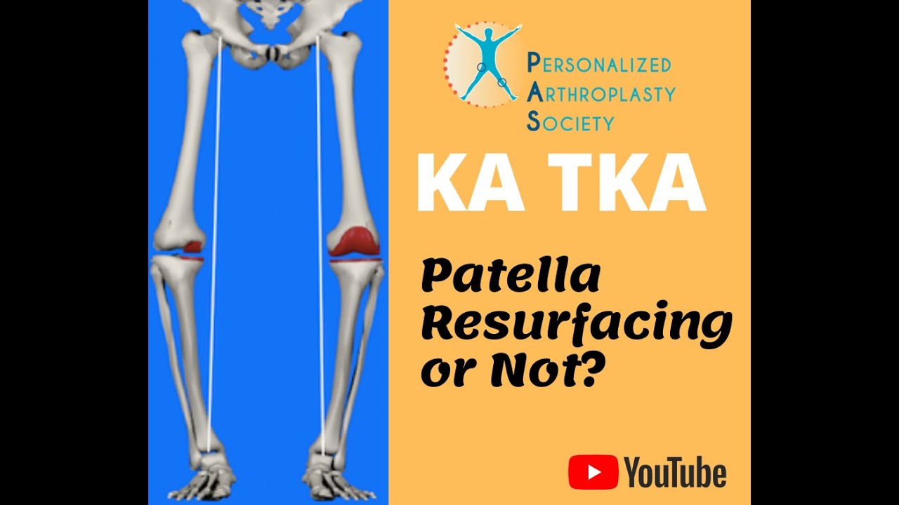 KA-TKA: Patella Resurfacing or Not? - Rational & Evidence