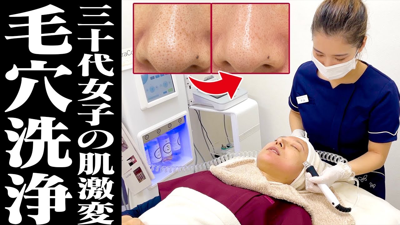 【毛穴洗浄 福岡】福岡の最新美容皮膚科で30代女子が毛穴洗浄した結果...