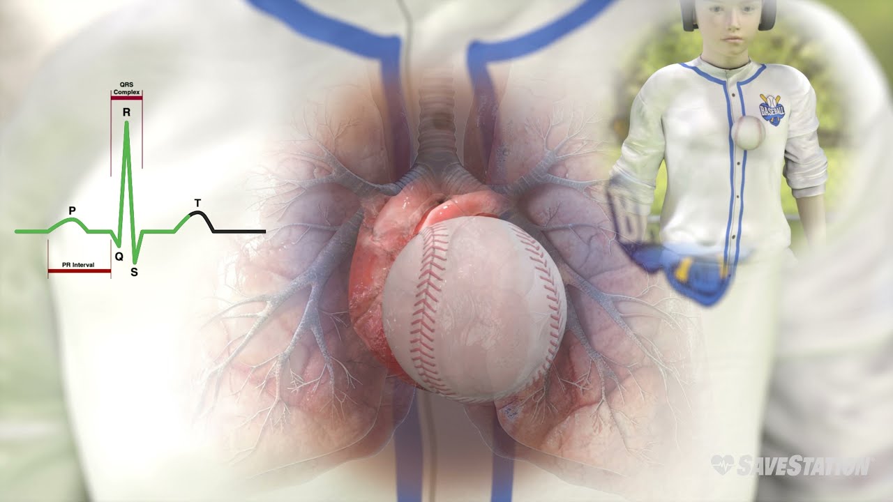 Commotio Cordis Explained Using 3D Animation