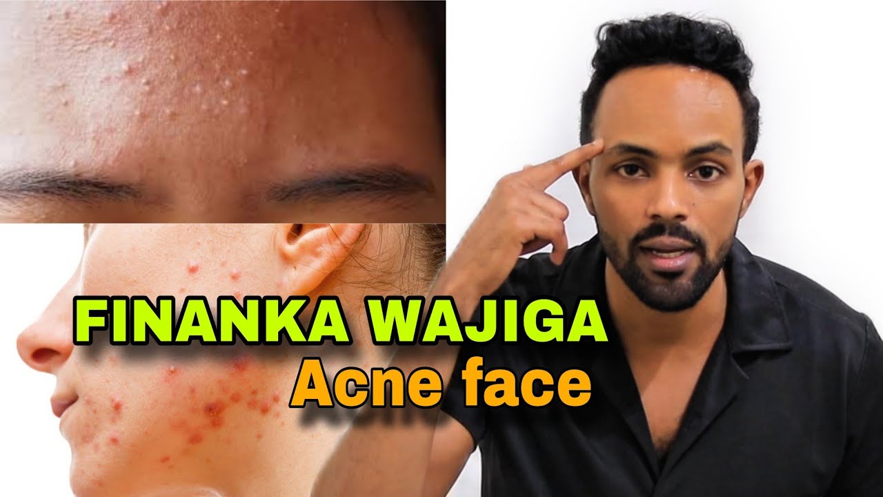2 SHAY FINANKA WAJIGA LAGU DAWEEYO |acne face|