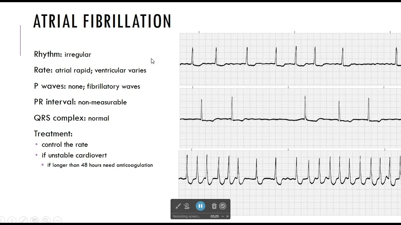 Atrial Dysrhythmias